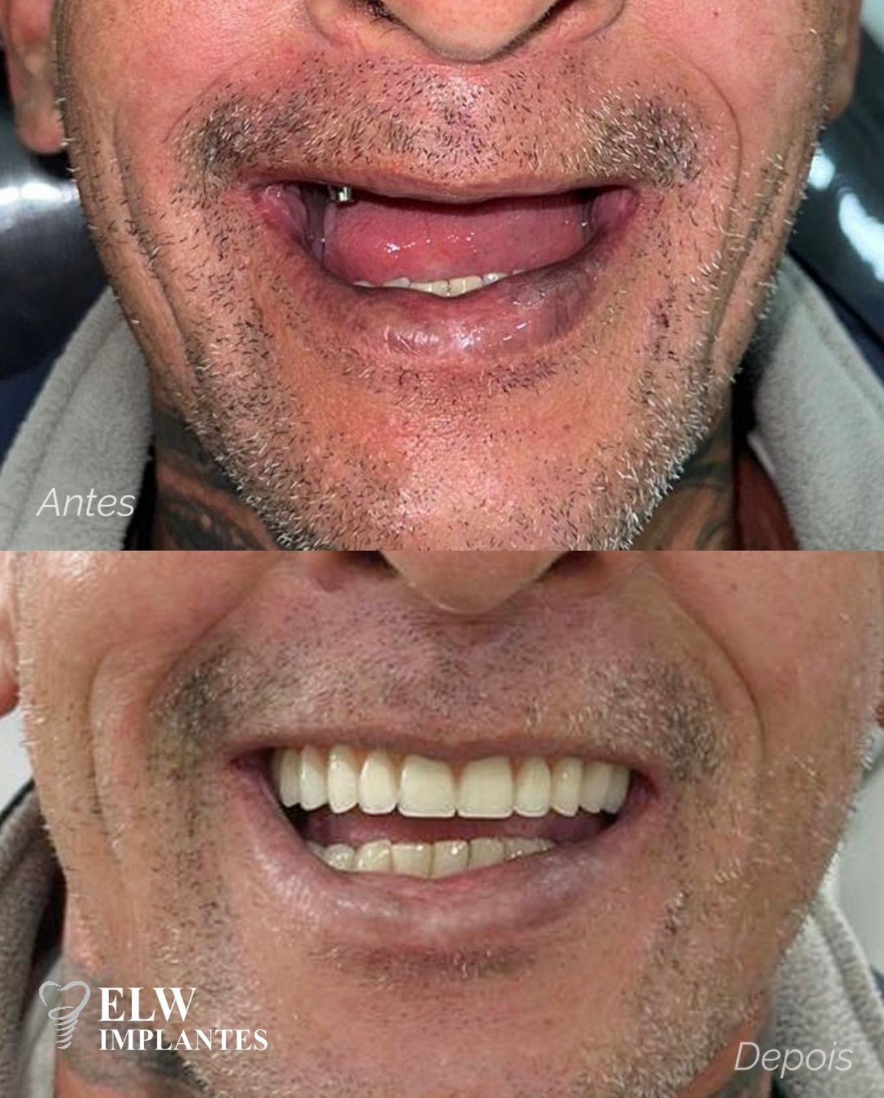 Antes e Depois