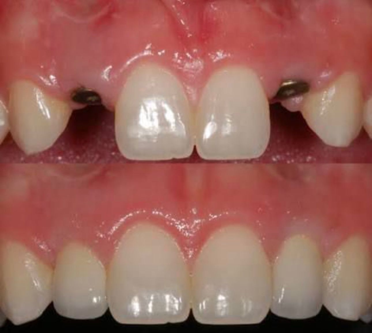 Antes e Depois